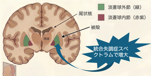 統合失調症スペクトラムに関連する 淡蒼球亜領域の特徴を発見 ――統合失調症や発症リスクに共通する淡蒼球外節体積増大を確認――